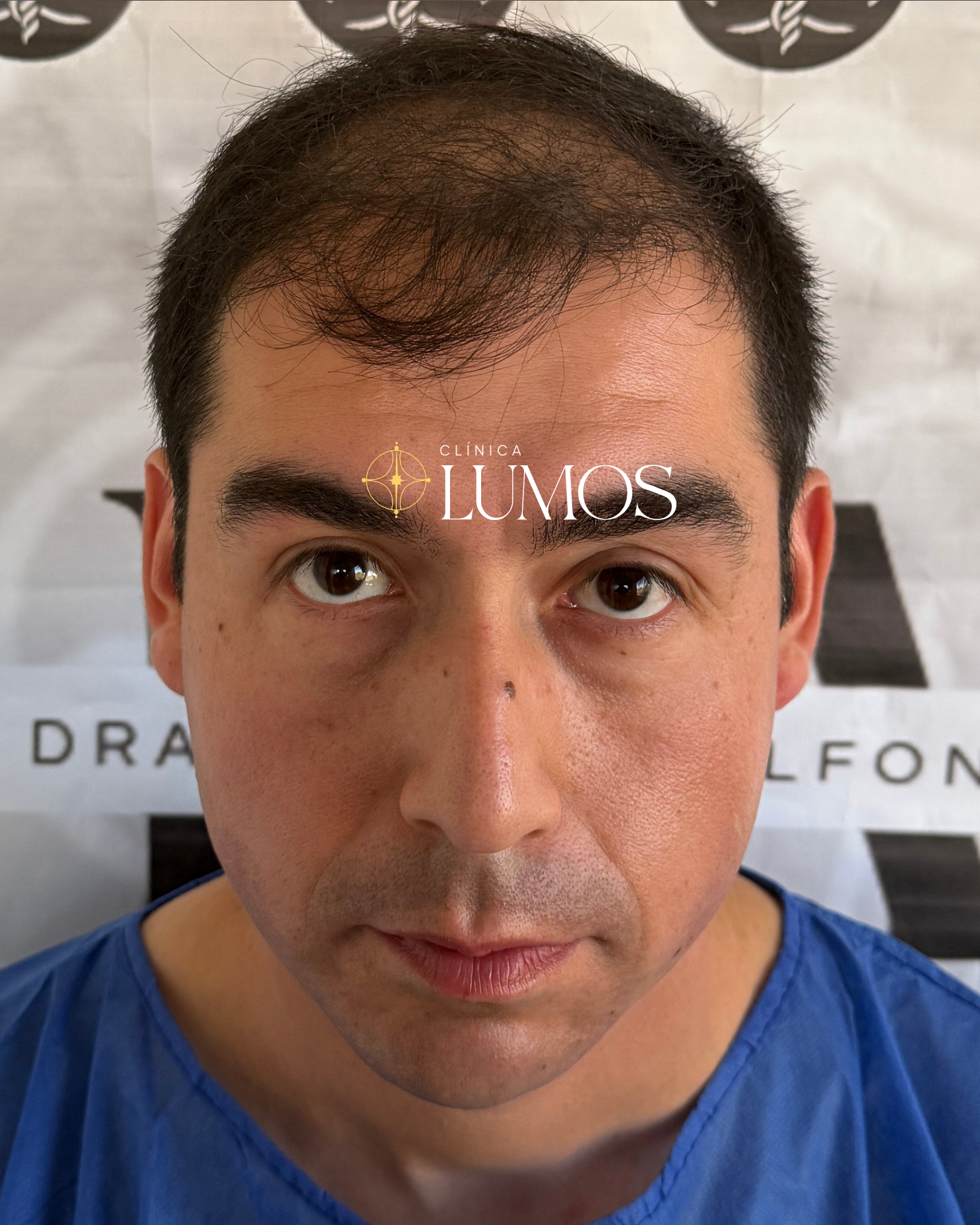 Antes del trasplante capilar: entradas frontales, vista frontal – Clínica Lumos Viña del Mar