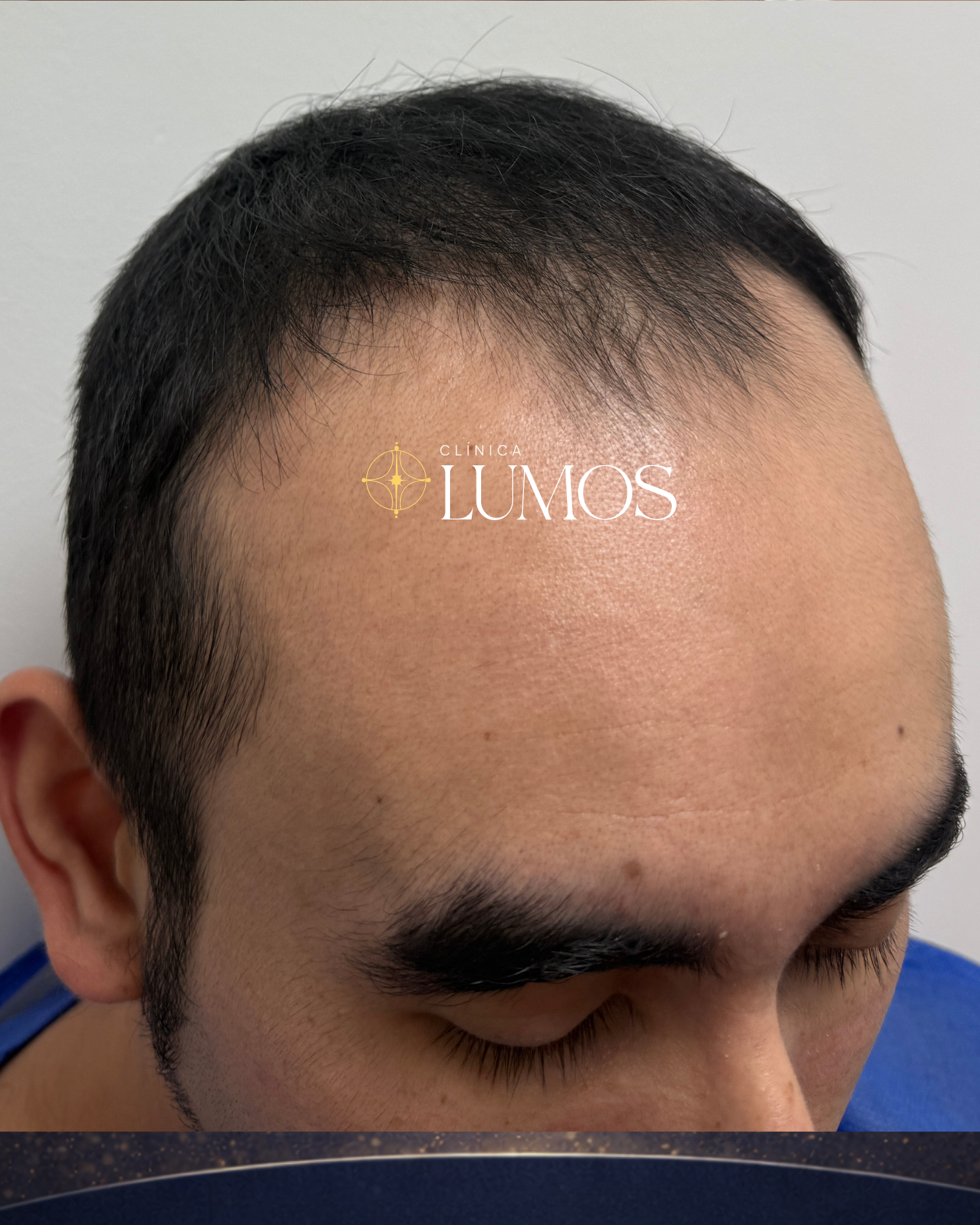 Antes del trasplante capilar: retroceso de la línea frontal, vista lateral – Clínica Lumos Viña del Mar