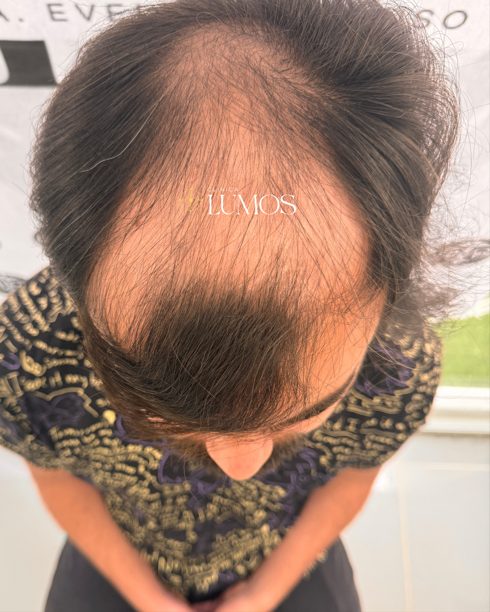 Antes del tratamiento capilar: alopecia en la coronilla, vista superior – Clínica Lumos Viña del Mar