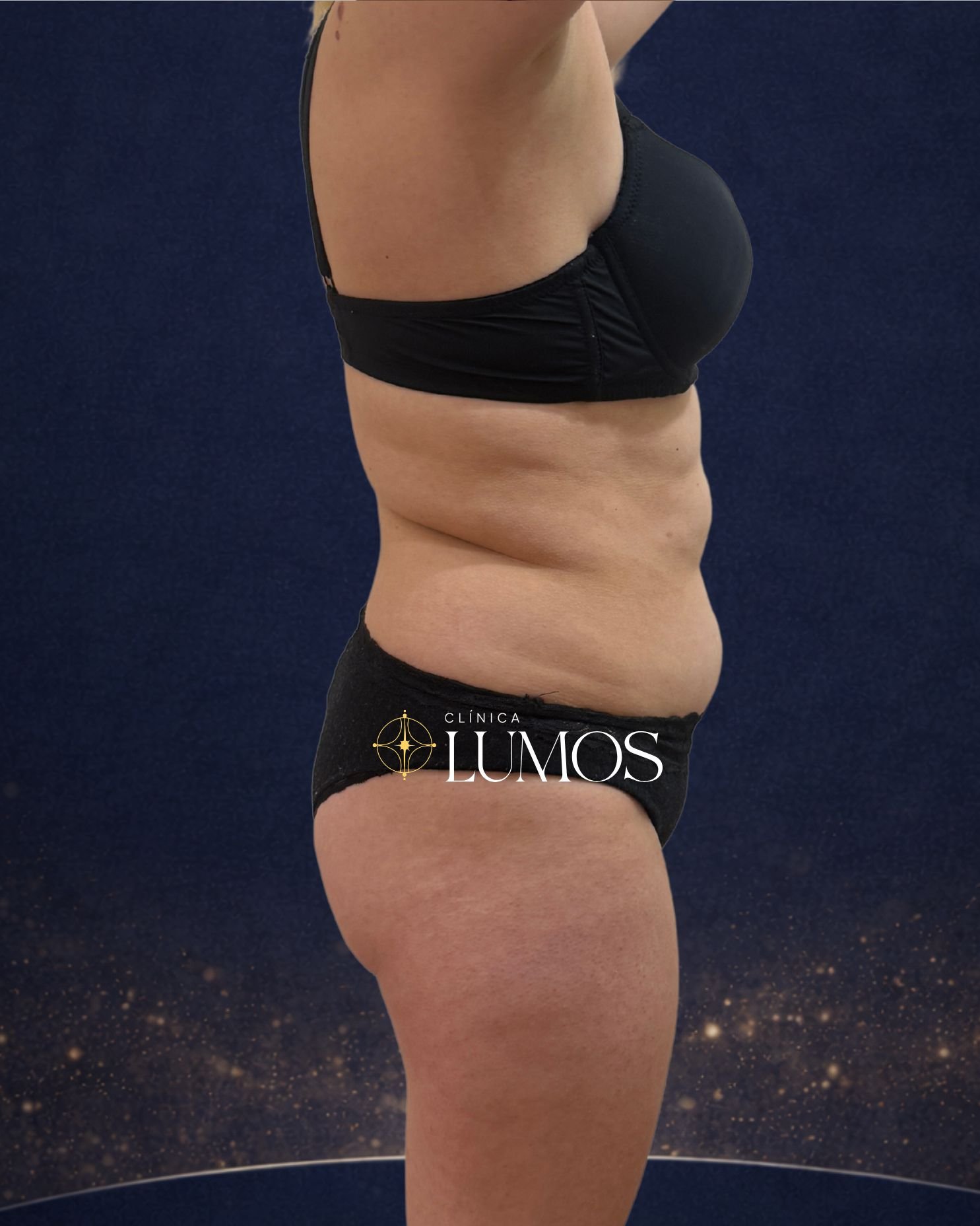 Resultado LipoVaser en abdomen y flancos, vista lateral – Clínica Lumos Viña del Mar
