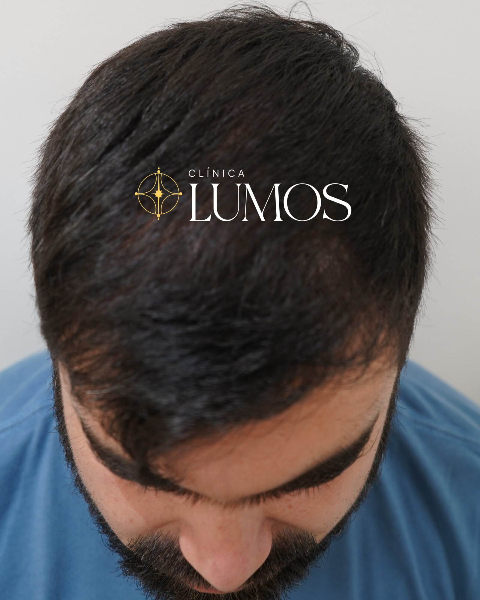 Resultado de trasplante capilar: densidad en zona frontal, vista superior – Clínica Lumos Viña del Mar